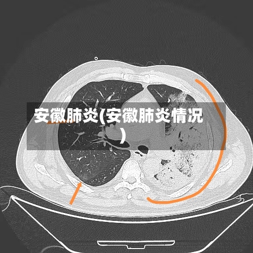 安徽肺炎(安徽肺炎情况)
