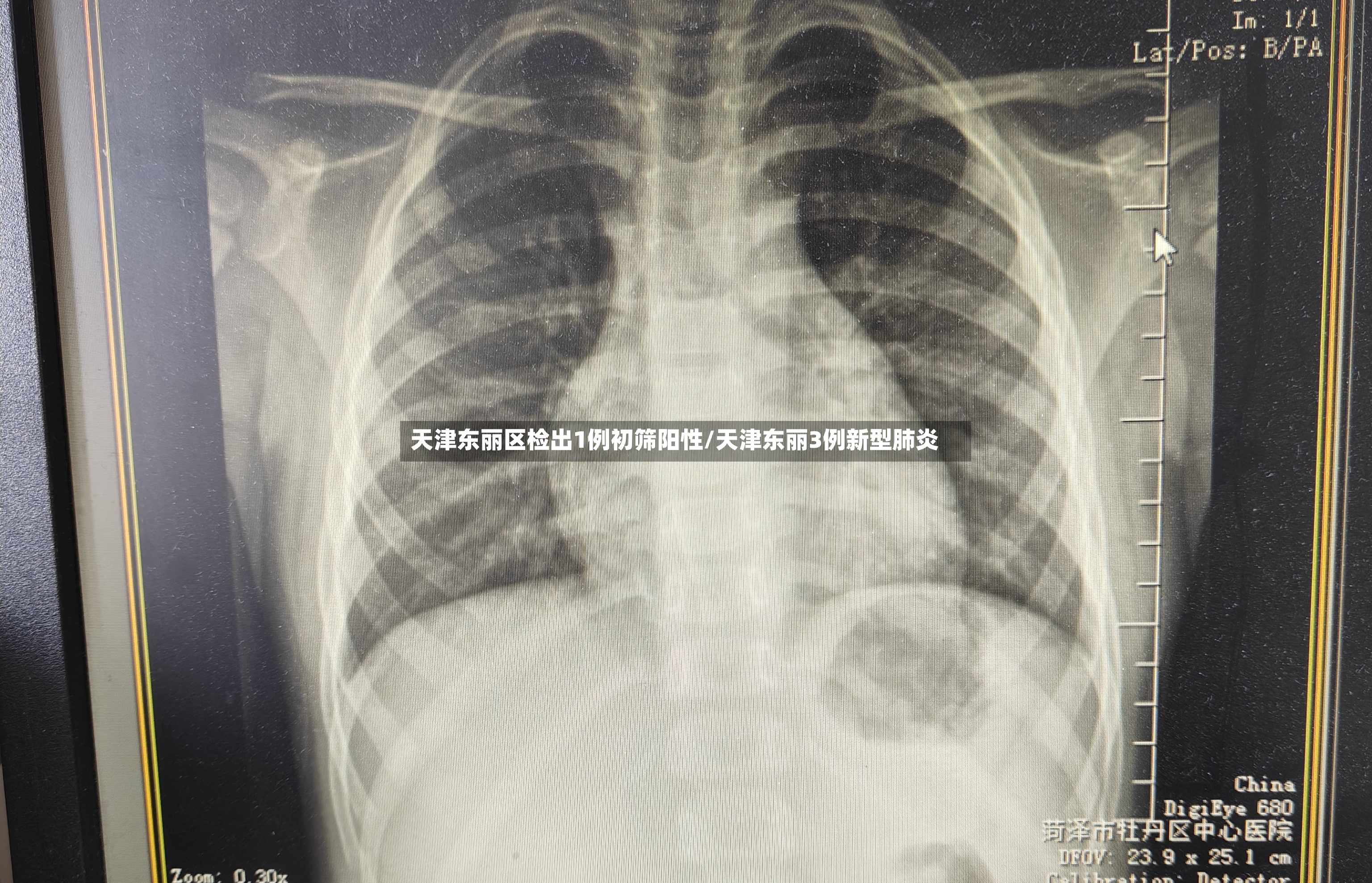 天津东丽区检出1例初筛阳性/天津东丽3例新型肺炎-第3张图片